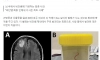 수술하던 의사도 기겁…건망증 여성 뇌에 8㎝ 벌레