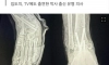 왼발 수술인데 오른발을 절단한 유명 정형외과