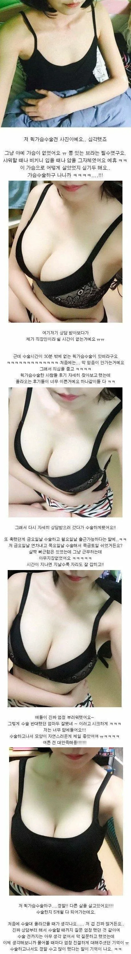 가슴 성형 후기