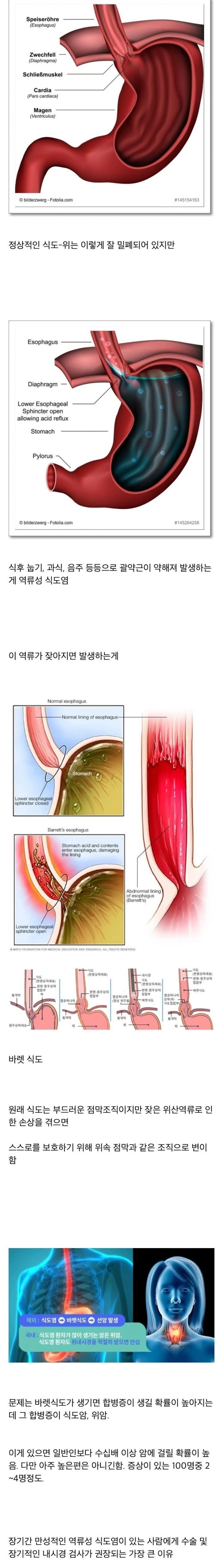역류성 식도염을 방치하면 위험한 이유...jpg