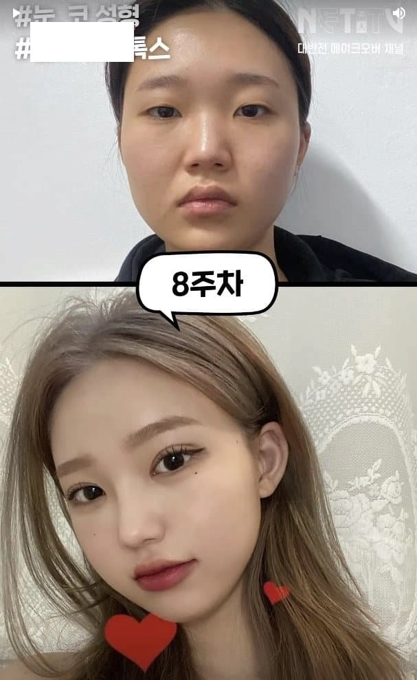 흔한 한국여자의 성형수술 전후사진 ㄷㄷ