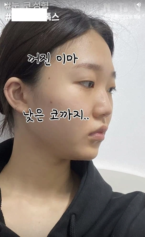 흔한 한국여자의 성형수술 전후사진 ㄷㄷ