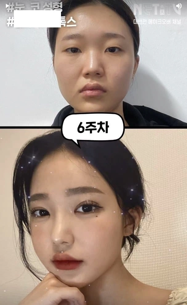 흔한 한국여자의 성형수술 전후사진 ㄷㄷ