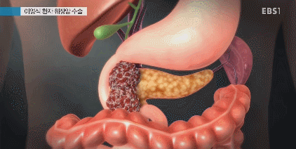최악의 암이라는 췌장암 수술....GIF