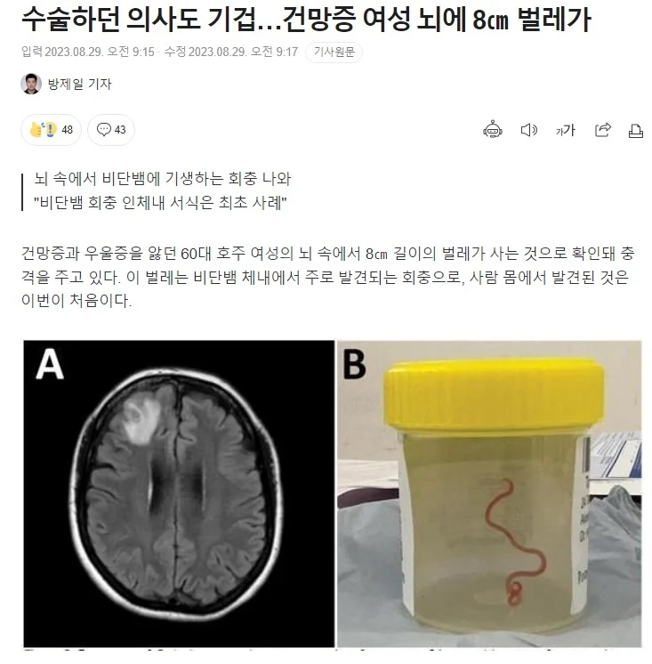수술하던 의사도 기겁…건망증 여성 뇌에 8㎝ 벌레