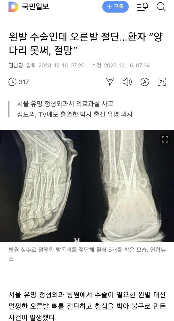 왼발 수술인데 오른발을 절단한 유명 정형외과