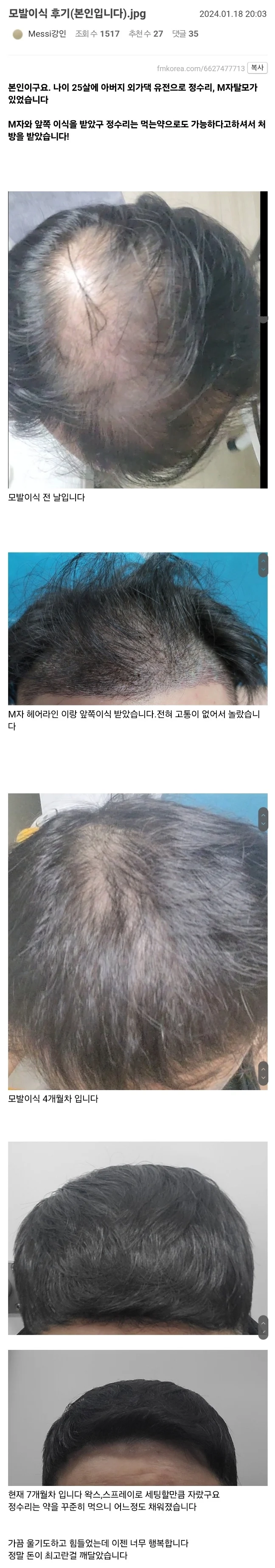 25살 대머리 모발이식 후기