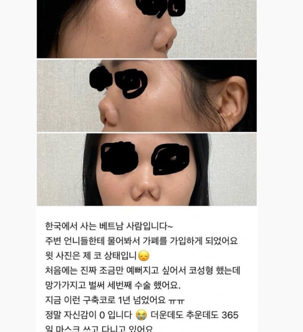 한국와서 코성형했다가 조져버린 베트남인