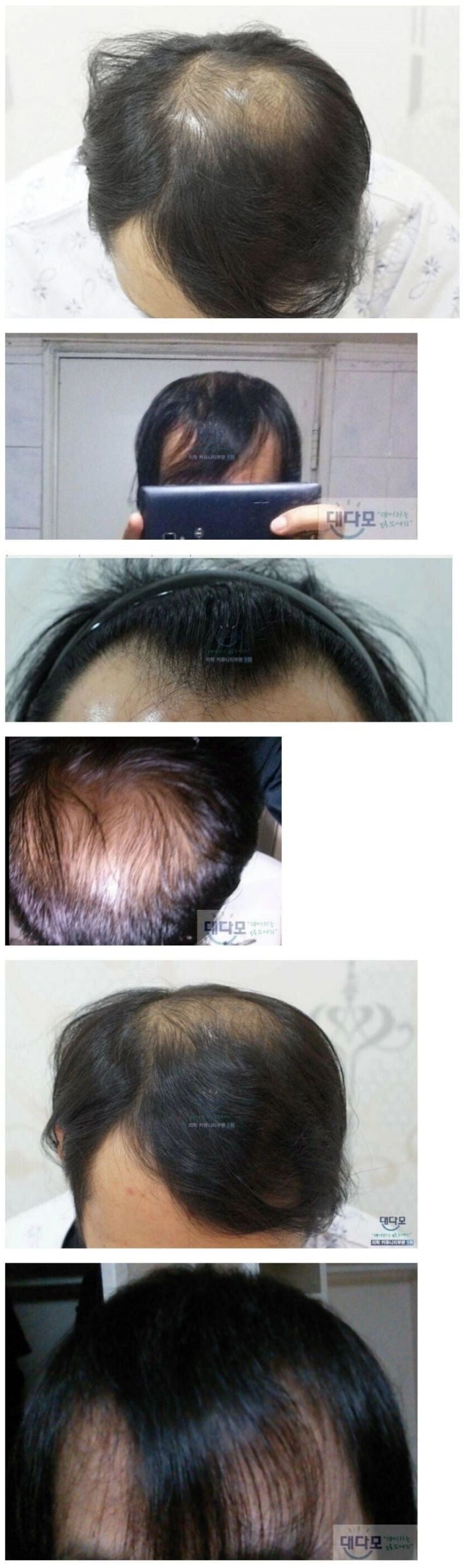 천만 원짜리 머리 심은 후기 이 정도면 성공 맞지?