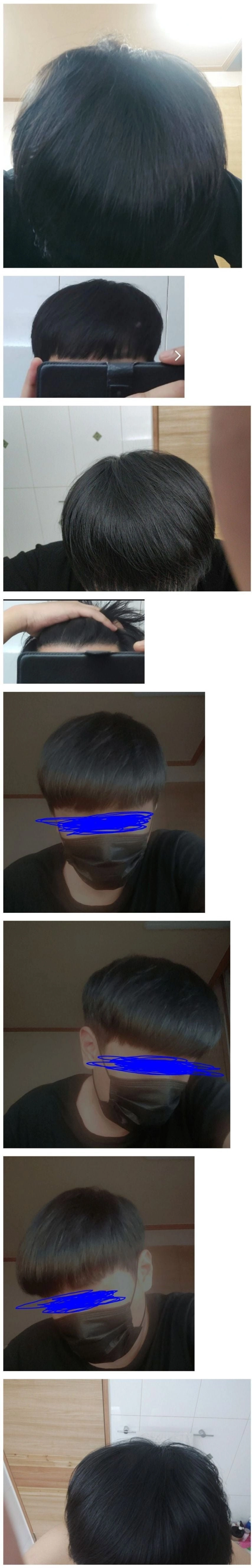 천만 원짜리 머리 심은 후기 이 정도면 성공 맞지?