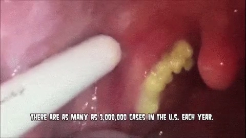 편도결석 제거 모음